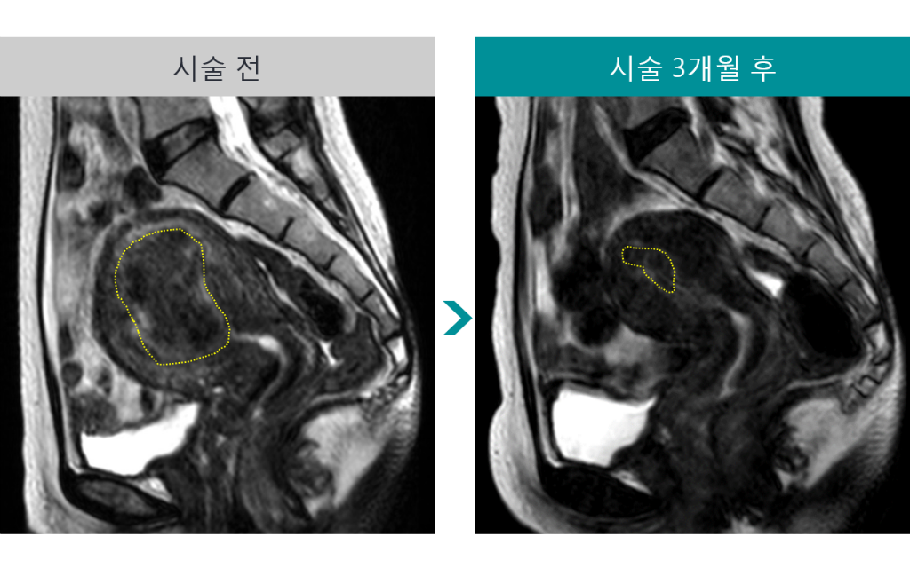 민트병원_MR하이푸2_46세 부정출혈.png