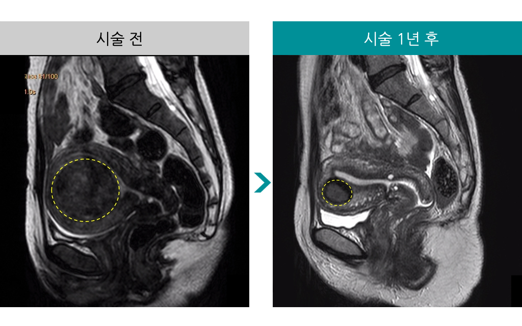 민트병원_자궁근종색전술시술전후02.jpg