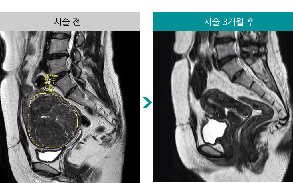 40세색전술후자궁경3개월변화.jpg