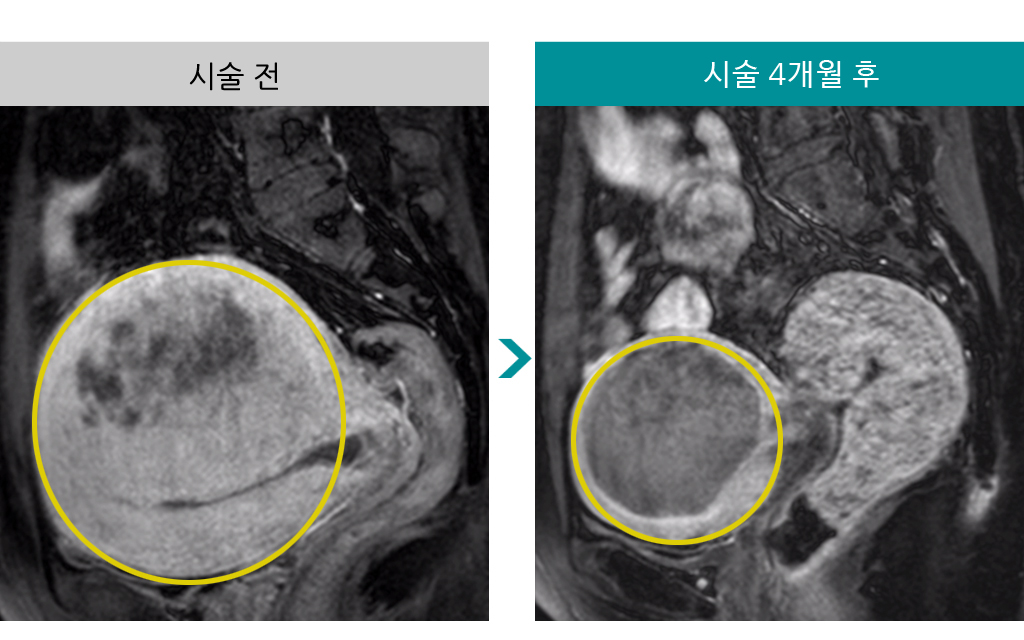 51세_선근증_색전술.jpg