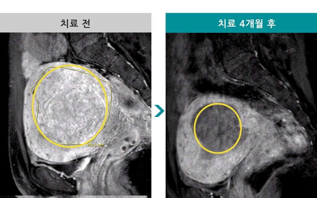 45세흘러내리는근종색전술.jpg